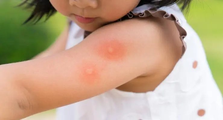 alergia-infantil