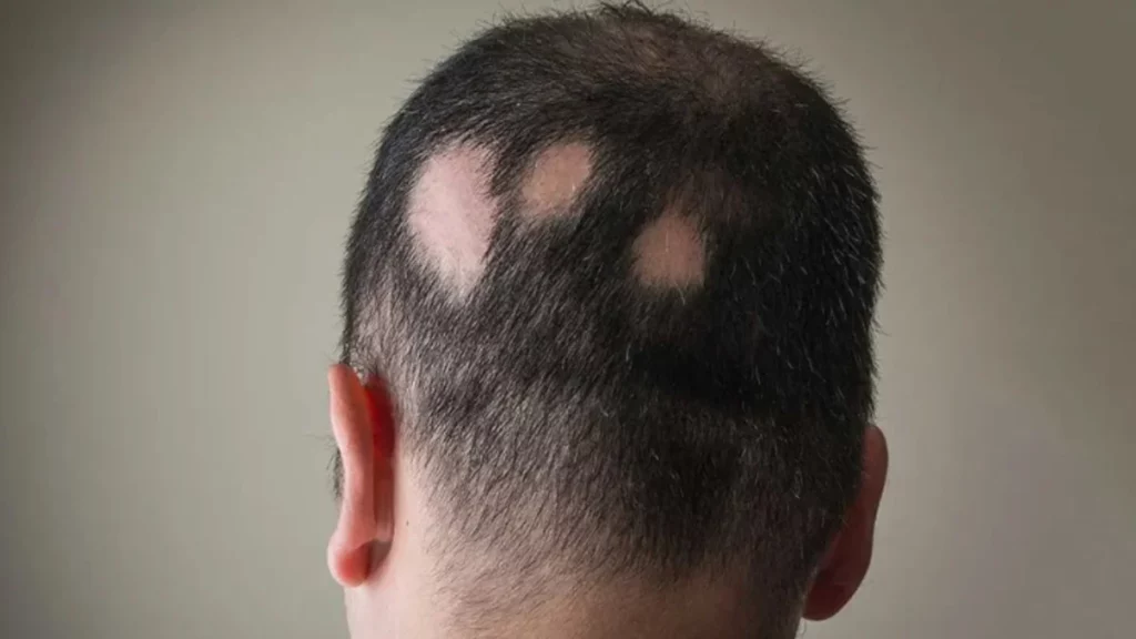 Alopecia Areata