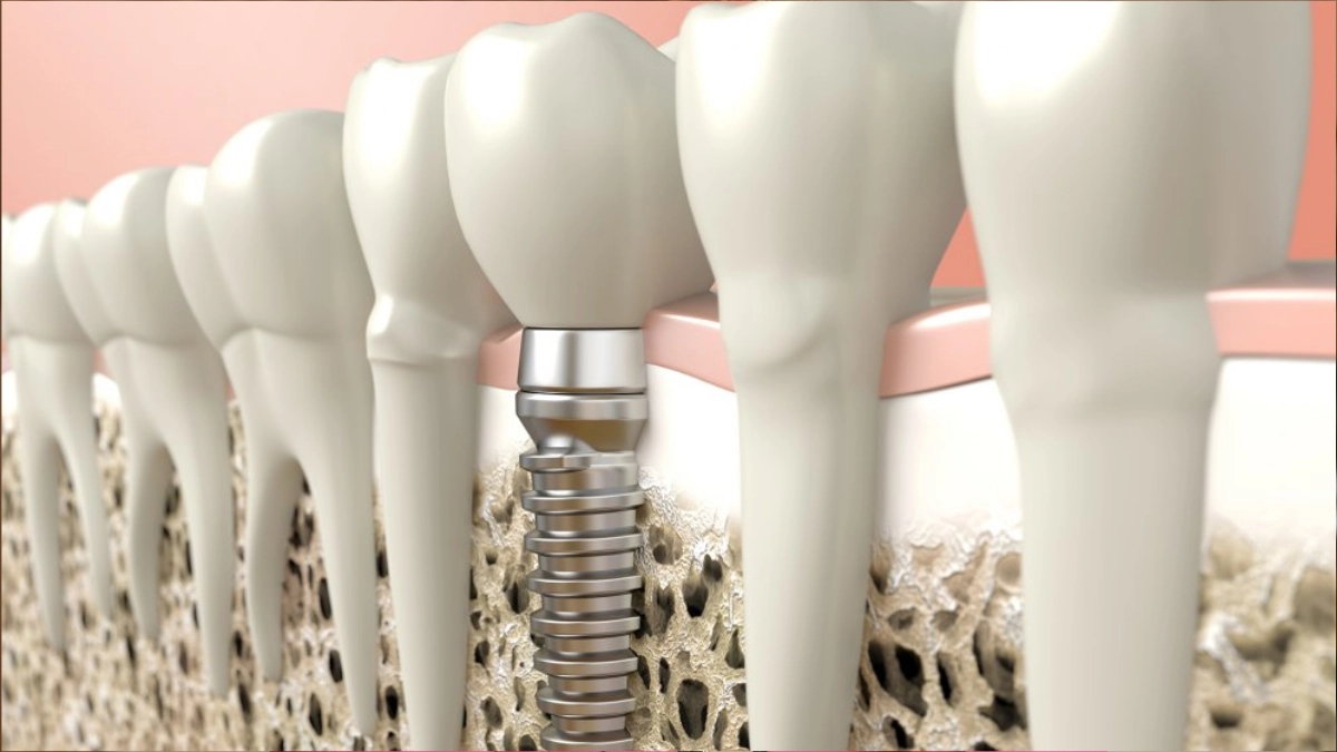 dr-rogerio-ferreira-odonto-implantes-zirconia