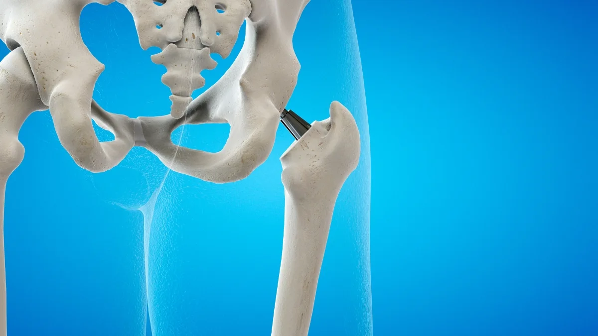 Depoimentos de Pessoas que Fizeram Cirurgia de Quadril