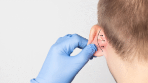 otoplastia-cirurgia-orelha-goiania-dr-abilio-vilela