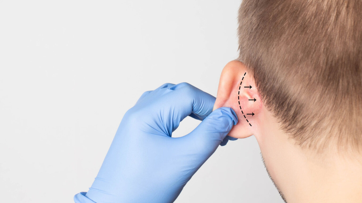 otoplastia-cirurgia-orelha-goiania-dr-abilio-vilela