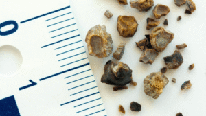calculo-renal-pedra-no-rim-cirurgia-rio-verde