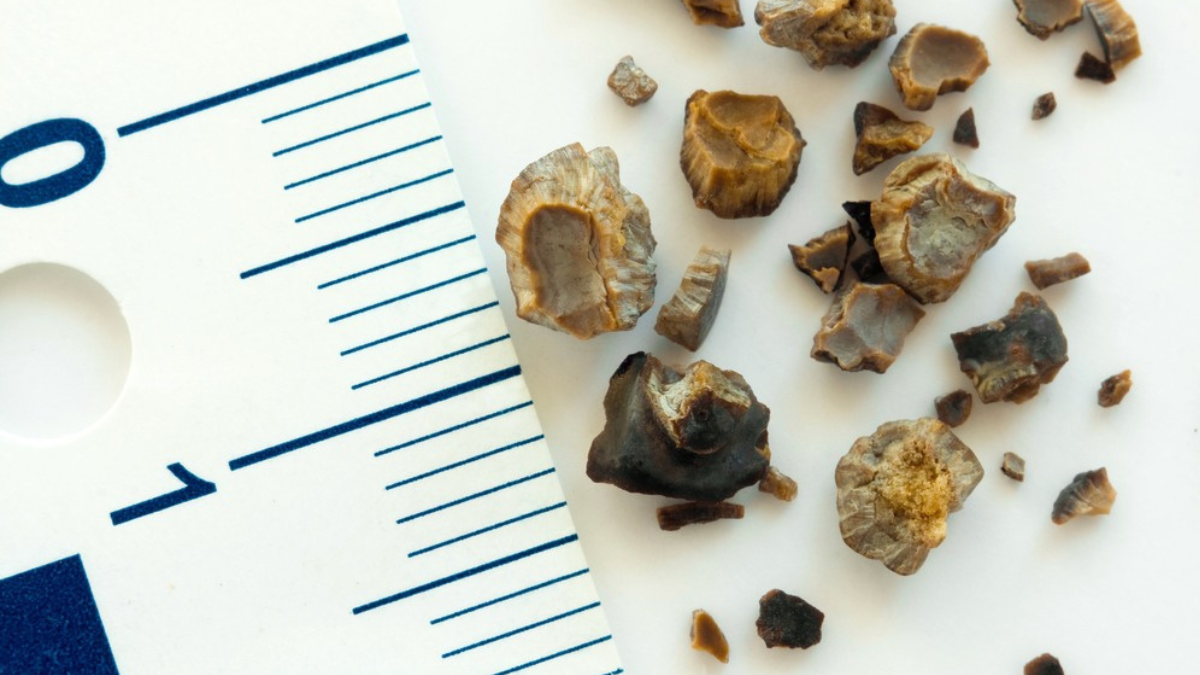 calculo-renal-pedra-no-rim-cirurgia-rio-verde