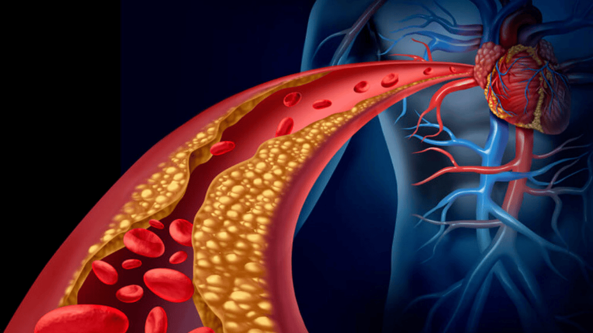 colesterol-infarto-derrame-dr-humberto-graner-goiania