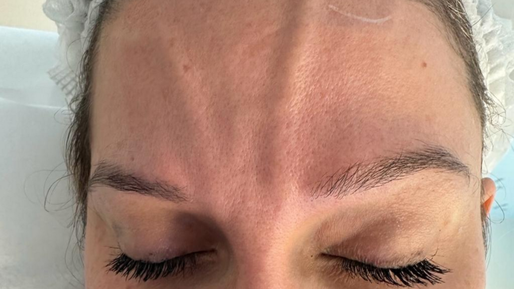 Tratamento das Veias da Testa